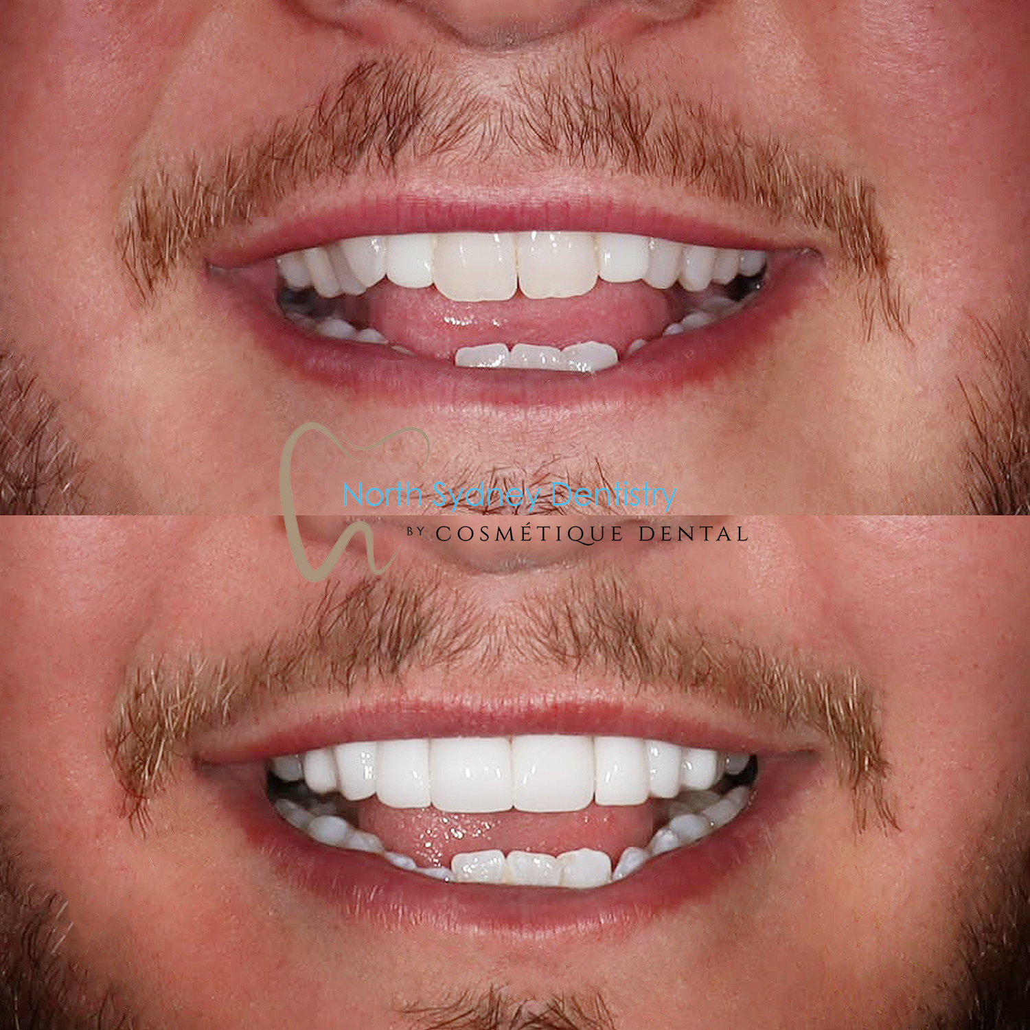 Porcelain Veneers At North Sydney Dentistry 