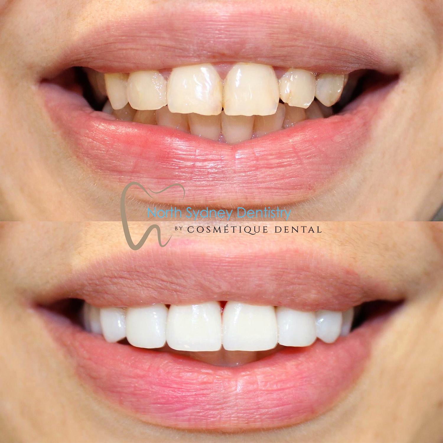 Porcelain Veneers at North Sydney Dentistry