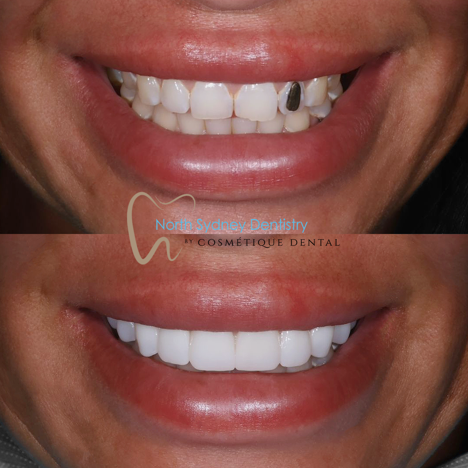 Porcelain Veneers at North Sydney Dentistry