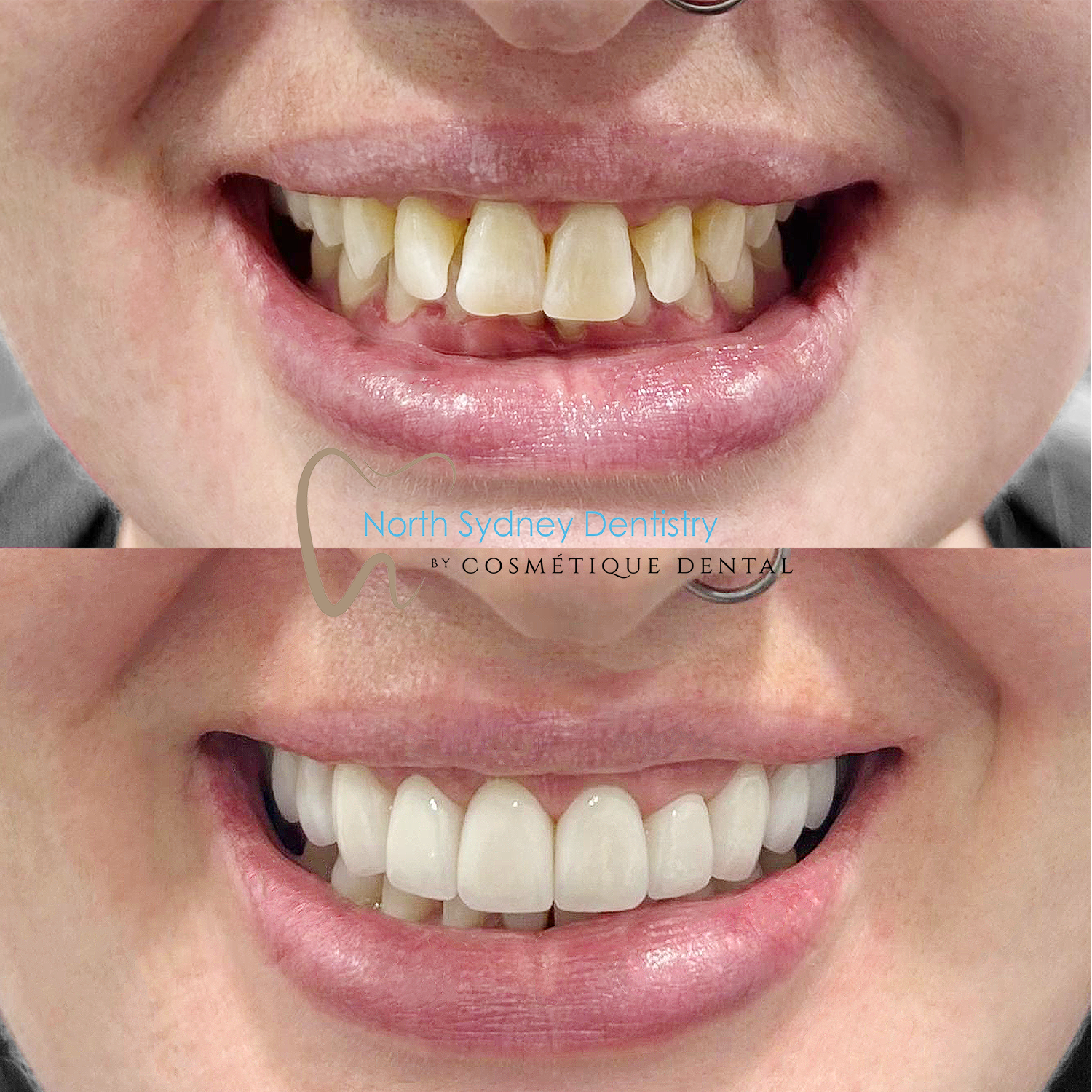Porcelain Veneers at North Sydney Dentistry