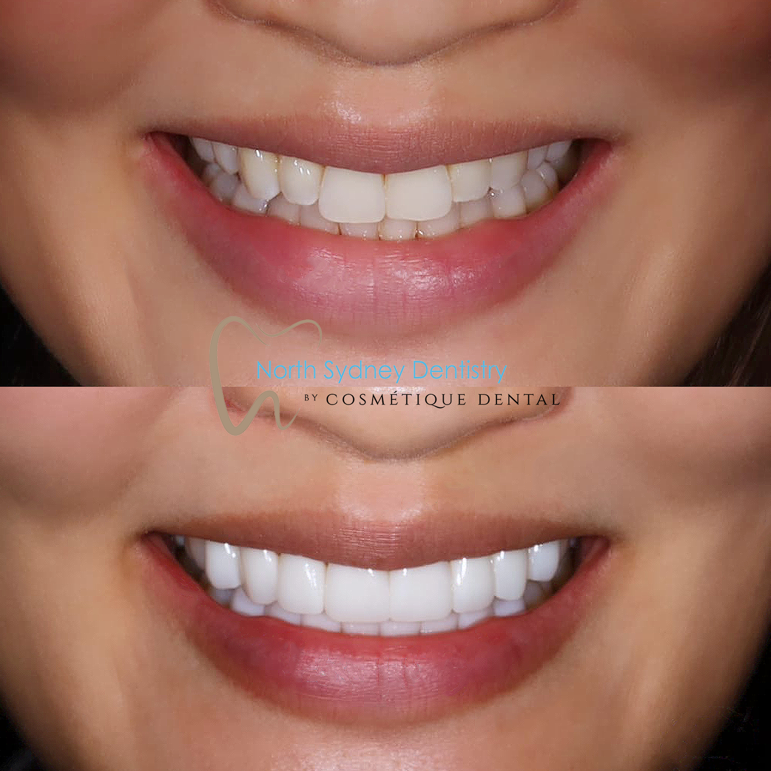 Porcelain Veneers at North Sydney Dentistry