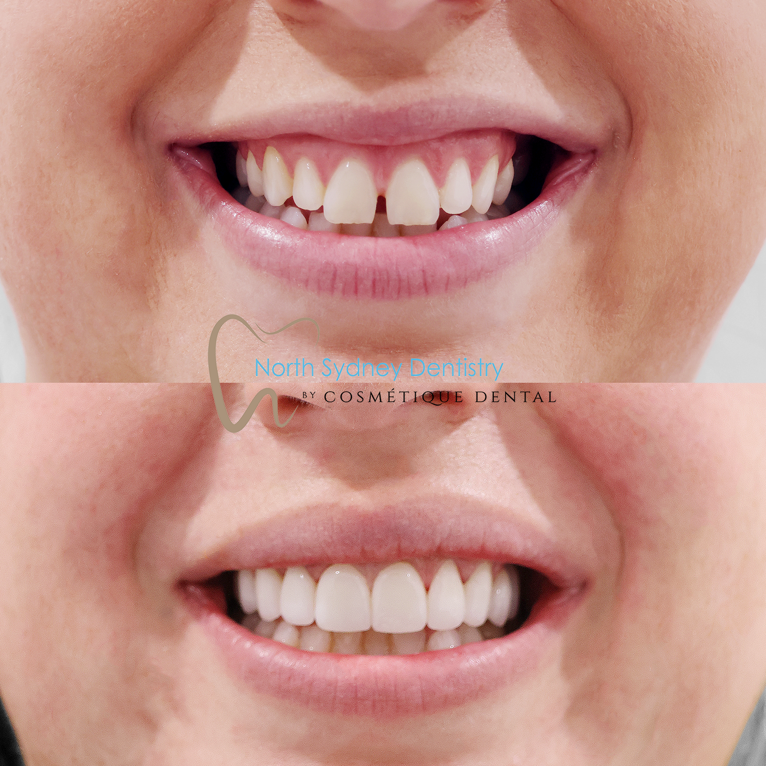Porcelain Veneers at North Sydney Dentistry