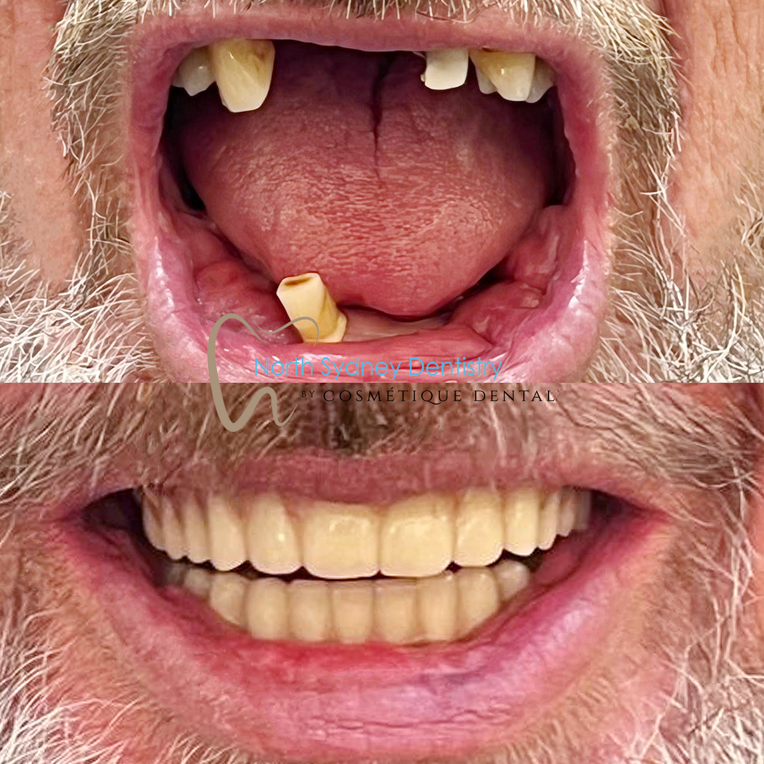 Dental Implant at North Sydney Dentistry