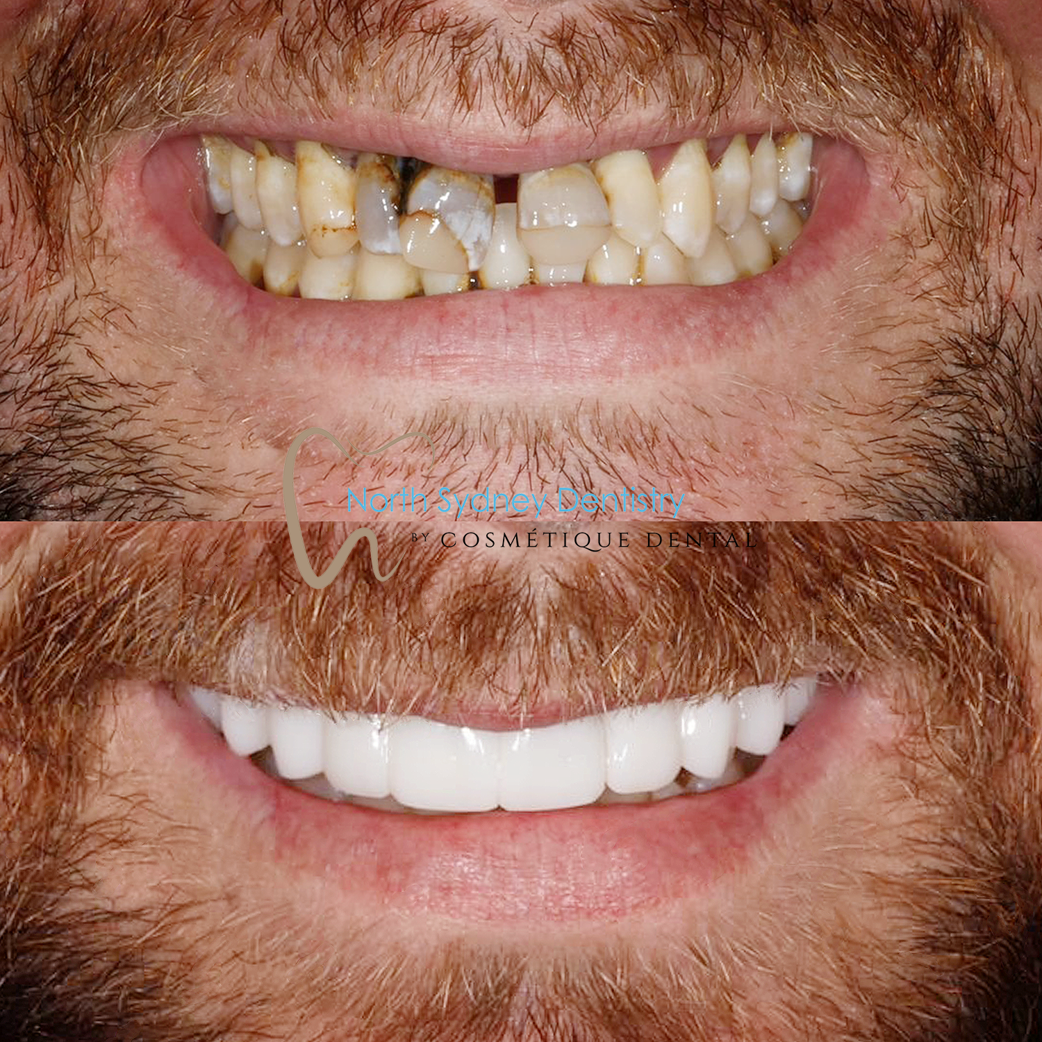 Dental Implant at North Sydney Dentistry