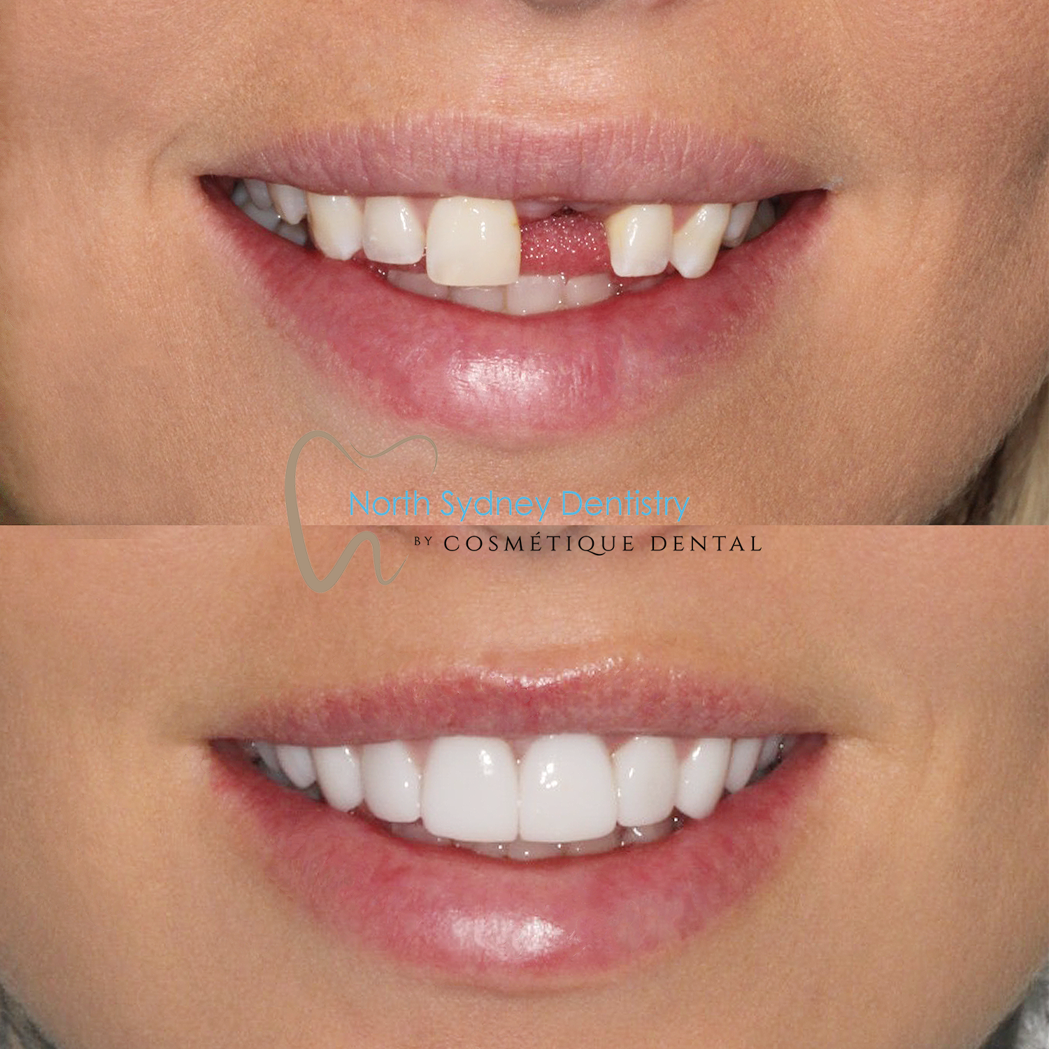 Dental Implant at North Sydney Dentistry
