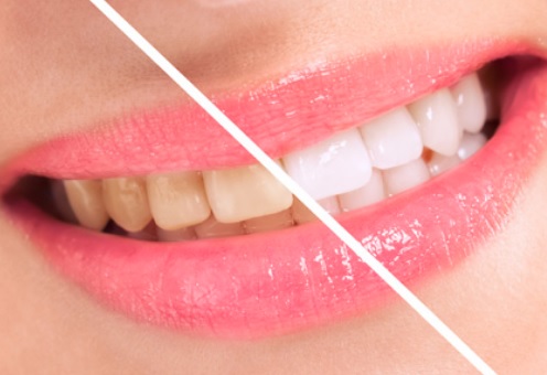 Teeth Whitening